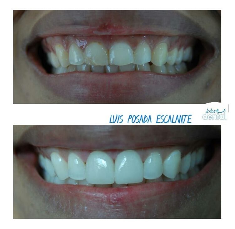 Dientes Antes y Despues