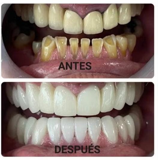 Rehabilitacion Oral