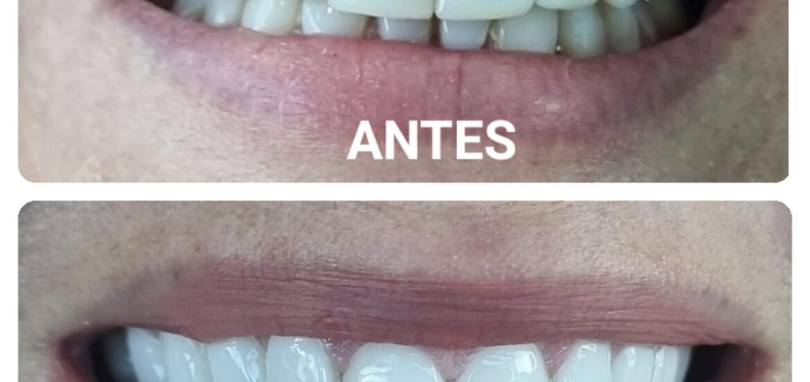 Dientes antes y despues