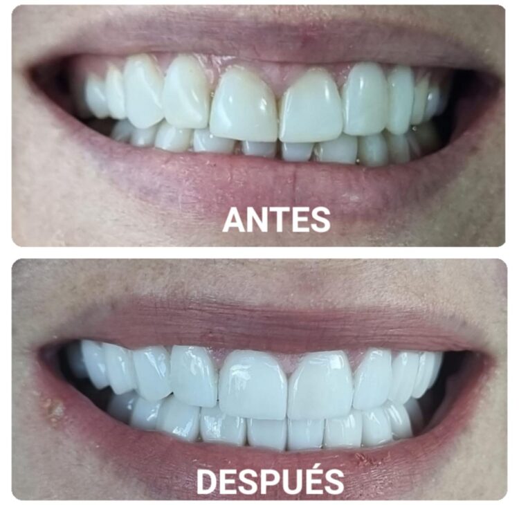 Dientes antes y despues